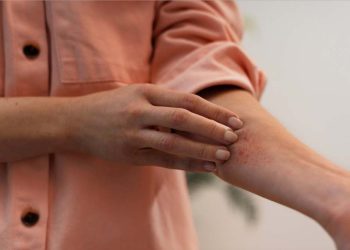 ¿Qué hacer ante picaduras de insectos  y cuando acudir a un centro de salud?