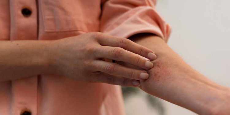 ¿Qué hacer ante picaduras de insectos  y cuando acudir a un centro de salud?